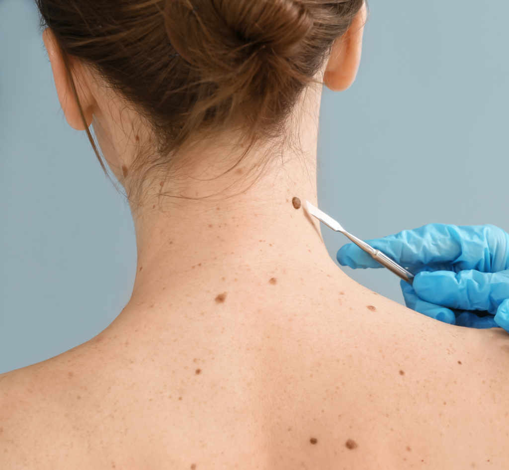 Doctor with Lancet Going to Remove Mole from Patient's Skin