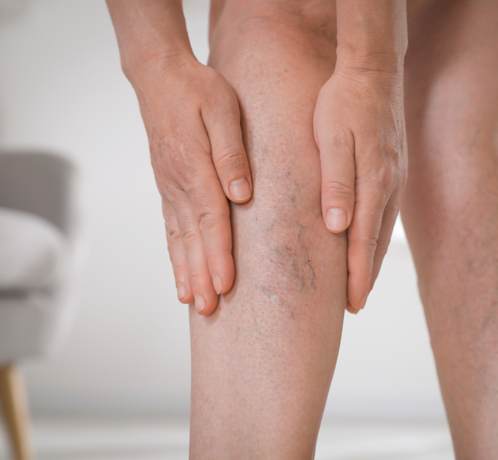 Woman Suffering from Varicose Veins Indoors