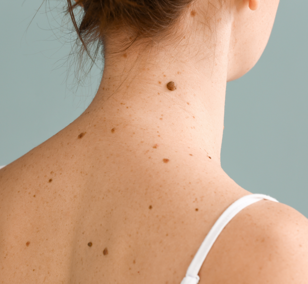 Young Woman with Moles on Grey Background