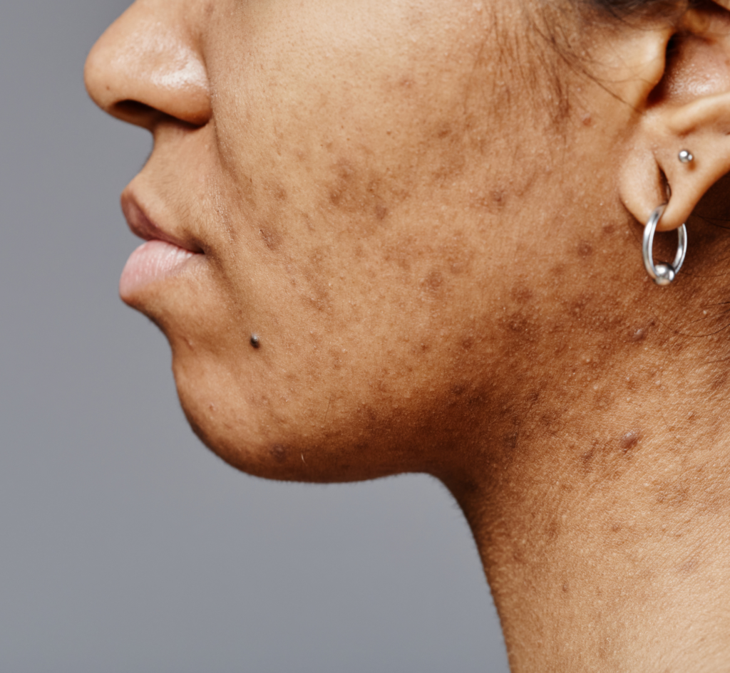 acne scars