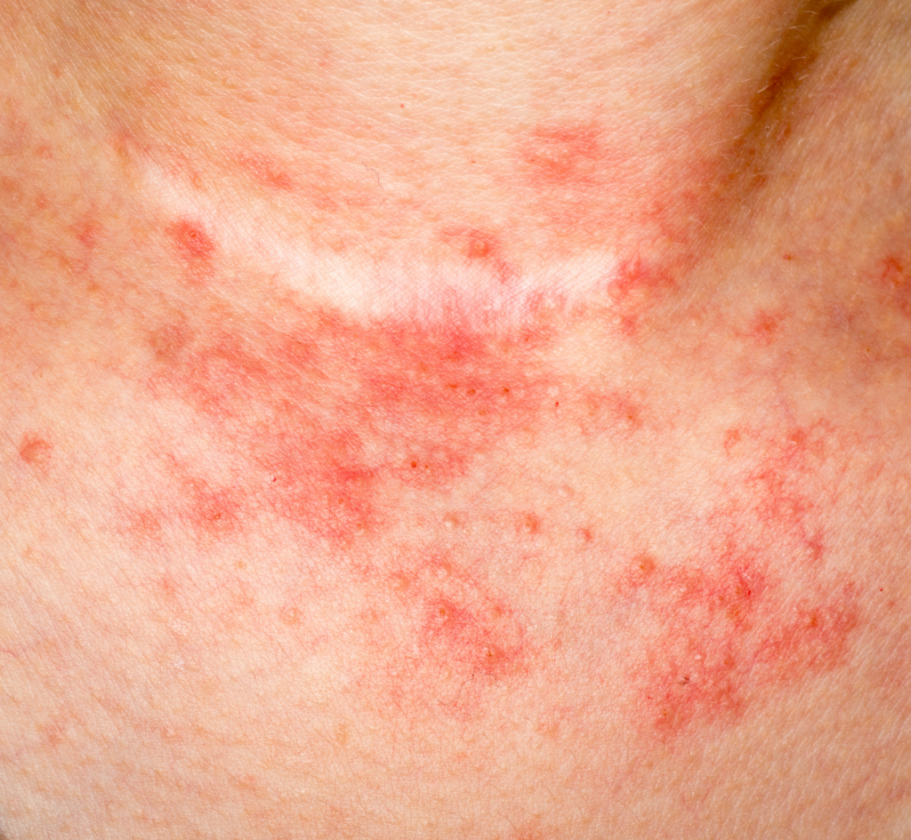 eczema on face