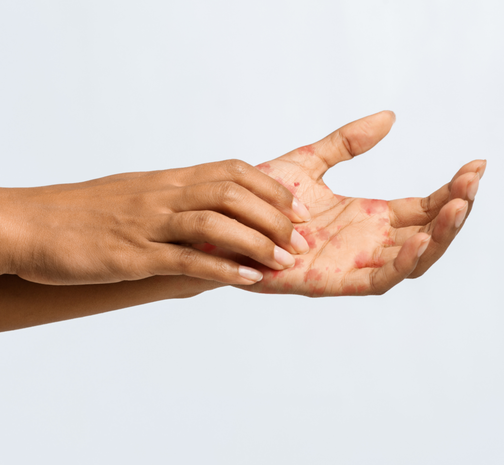 hand eczema