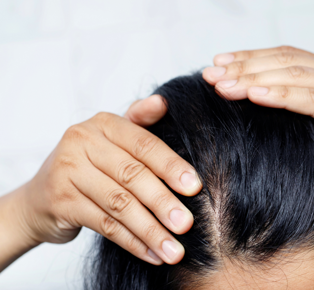 scalp eczema